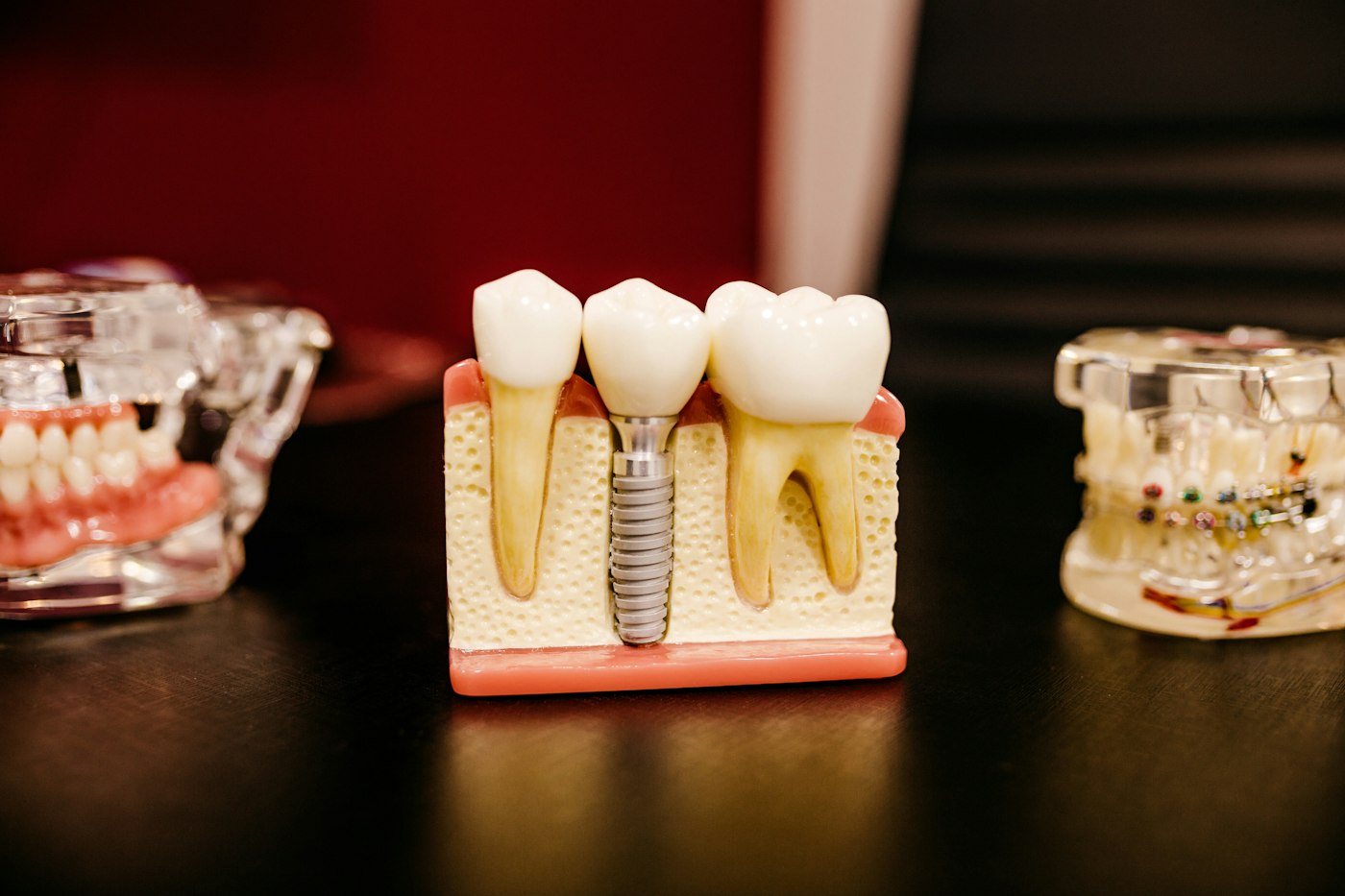 Maqueta de un implante dental junto a dientes naturales